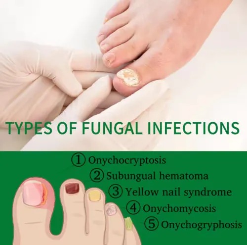 Nail Fungus Treatments Product